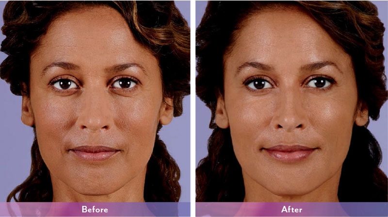 Juvederm® Before & After