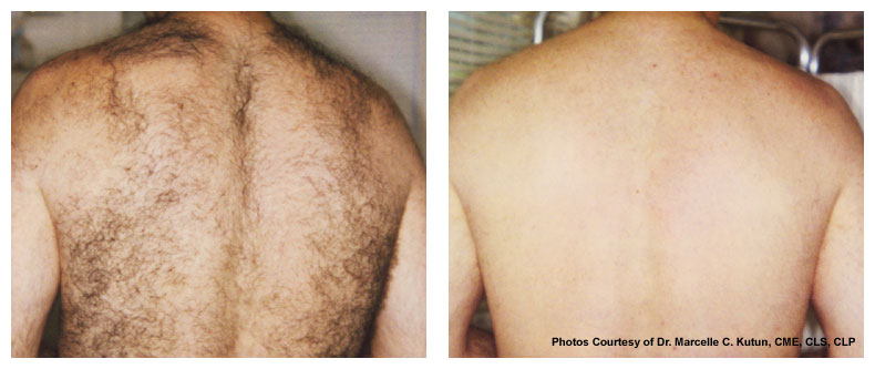 Laser Hair Removal Before & After Boca Raton, Pompano Beach And Fort Lauderdale