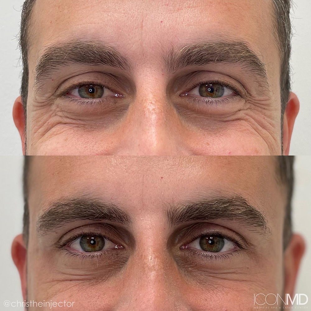 Botox® Before and After Photo by IconMD Medical Spa & Laser Center in Boca Raton Photo