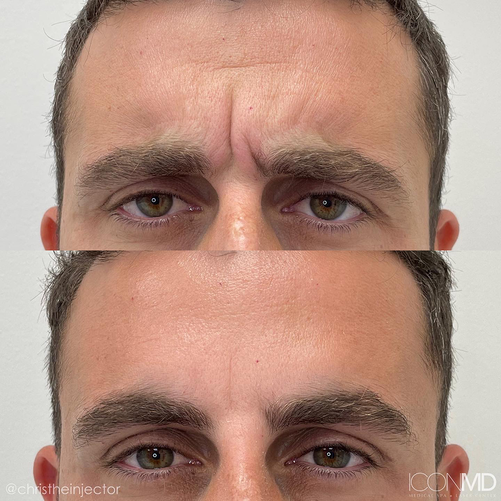 Botox® Before and After Photo by IconMD Medical Spa & Laser Center in Boca Raton
