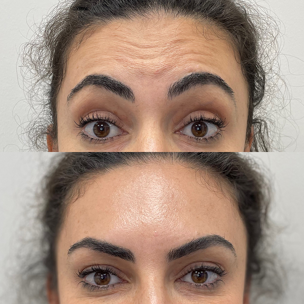 Botox® Before and After Photo by IconMD Medical Spa & Laser Center in Boca Raton