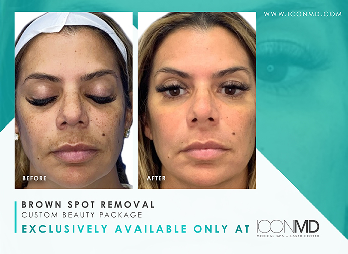 IconMD Brown Spot Removal Promo