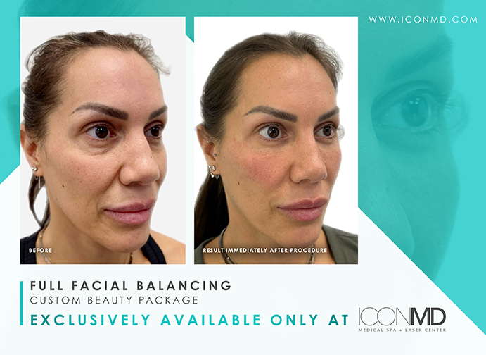 IconMD Facial Balancing Promo