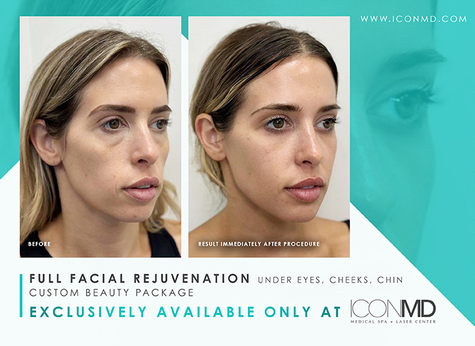 IconMD Facial Rejuvenation 2 Promo