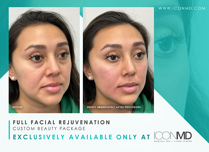 IconMD Facial Rejuvenation 1 Promo