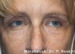 Morpheus 8