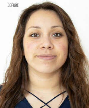 HydraFacial®