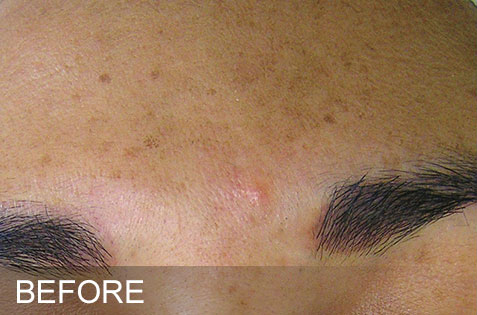 HydraFacial®
