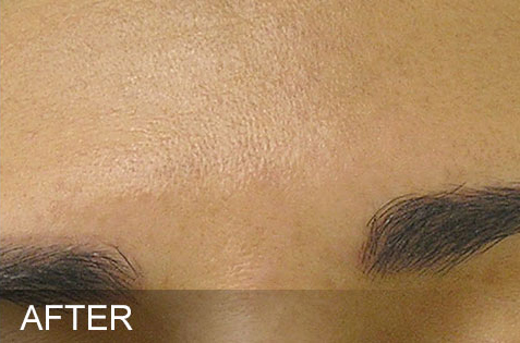 HydraFacial®