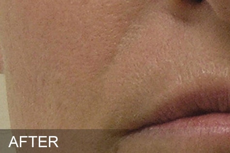 HydraFacial®