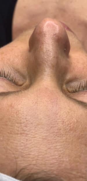 HydraFacial®