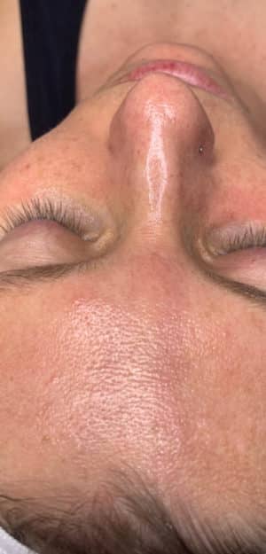 HydraFacial