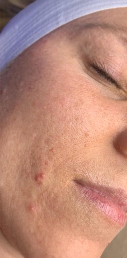 HydraFacial®
