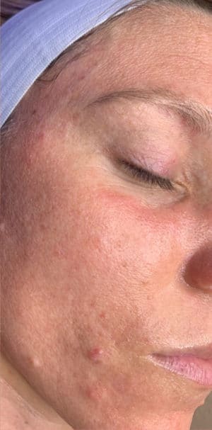 HydraFacial®