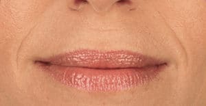 Juvederm