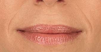 Juvederm