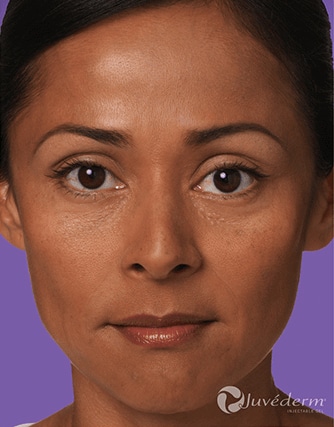 Juvederm