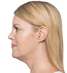 Kybella