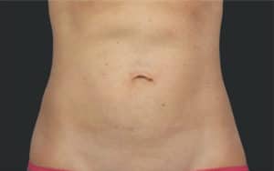 Coolsculpting Elite