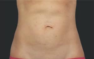 Coolsculpting Elite