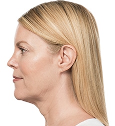 Kybella