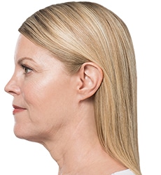 Kybella