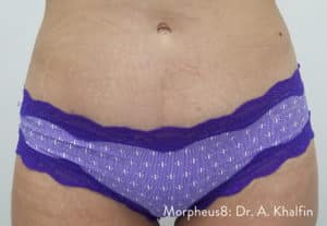 Morpheus8