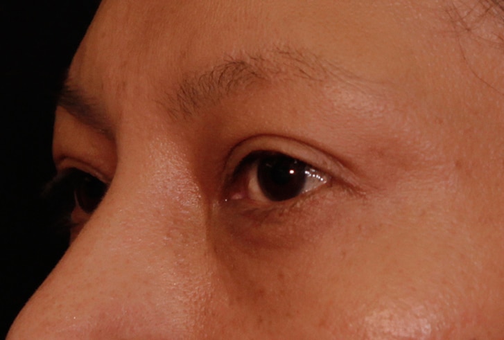 Morpheus8