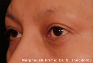 Morpheus8