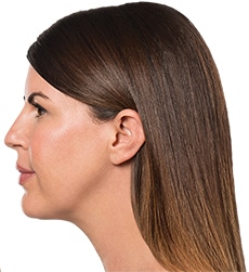 Kybella