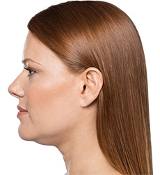 Kybella