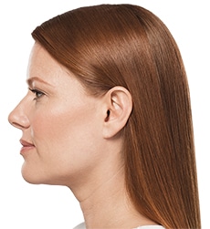 Kybella