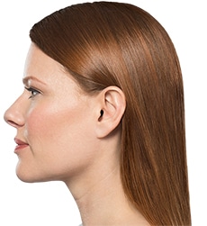 Kybella