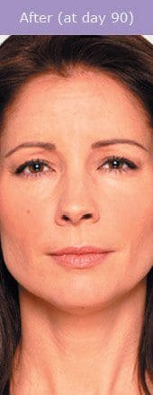 Botox