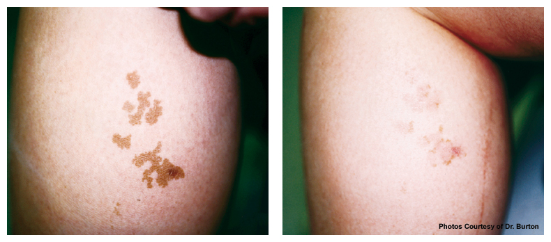 Brown Spot Removal Before & After