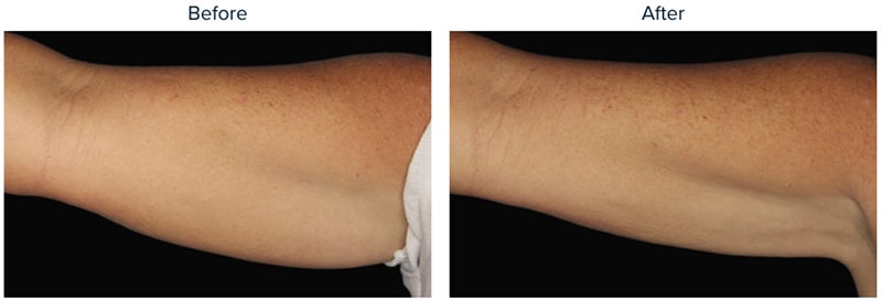 CoolSculpting® Elite Before & After