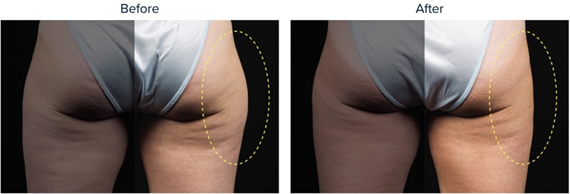 CoolSculpting® Elite Before & After