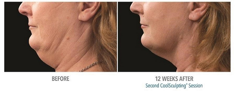 CoolSculpting® Elite Before & After