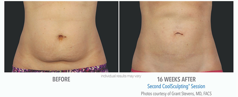 CoolSculpting® Elite Before & After