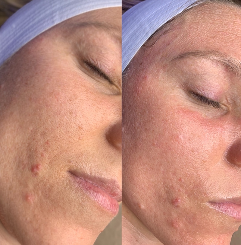 HydraFacial Before & After