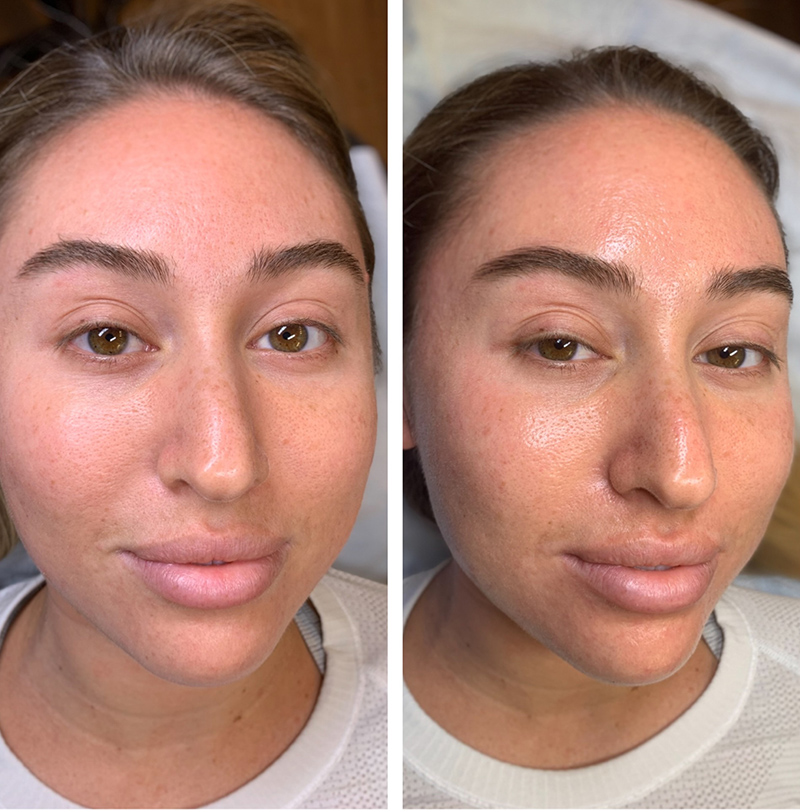 HydraFacial Before & After