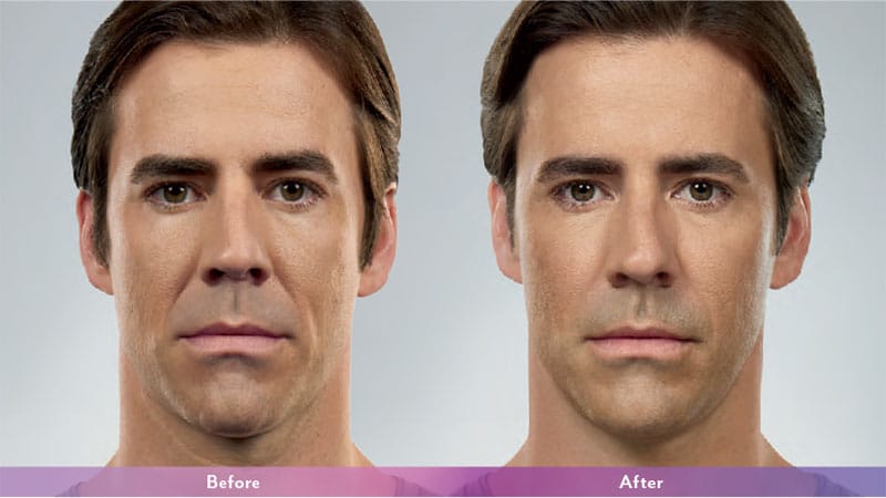Juvederm® Before & After