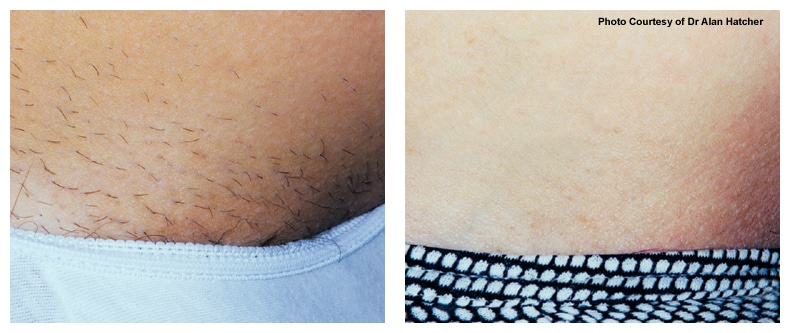 Laser Hair Removal Before & After Boca Raton, Pompano Beach And Fort Lauderdale