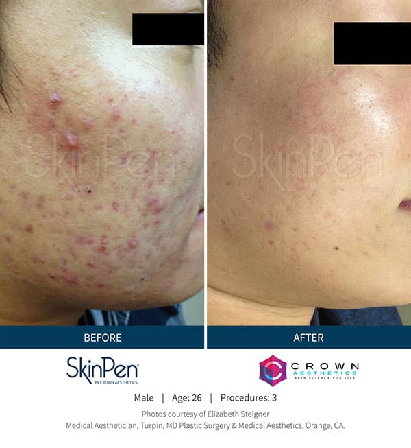 MicroNeedling Before & After