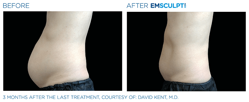 EMSculpt NEO Before & After