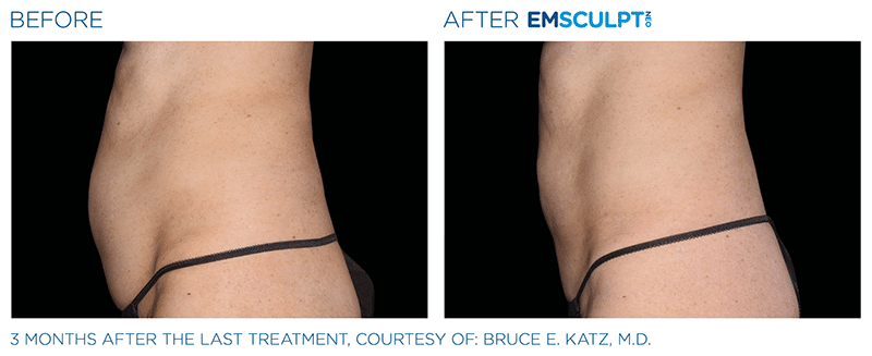 EMSculpt NEO Before & After