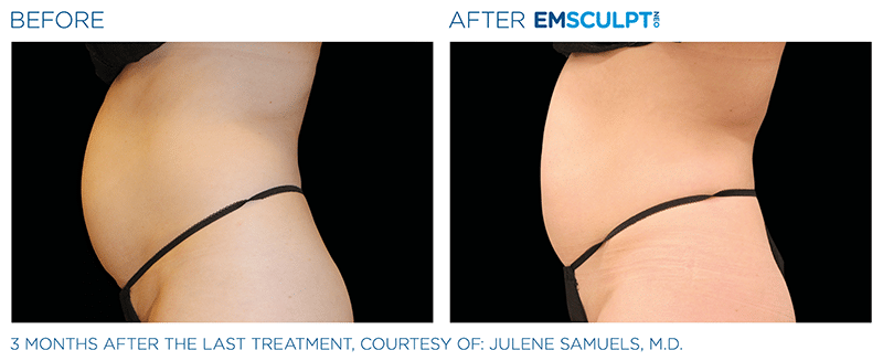 EMSculpt NEO Before & After