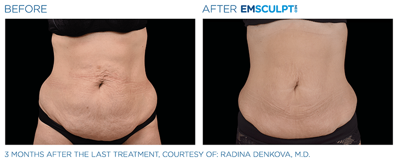 EMSculpt NEO Before & After