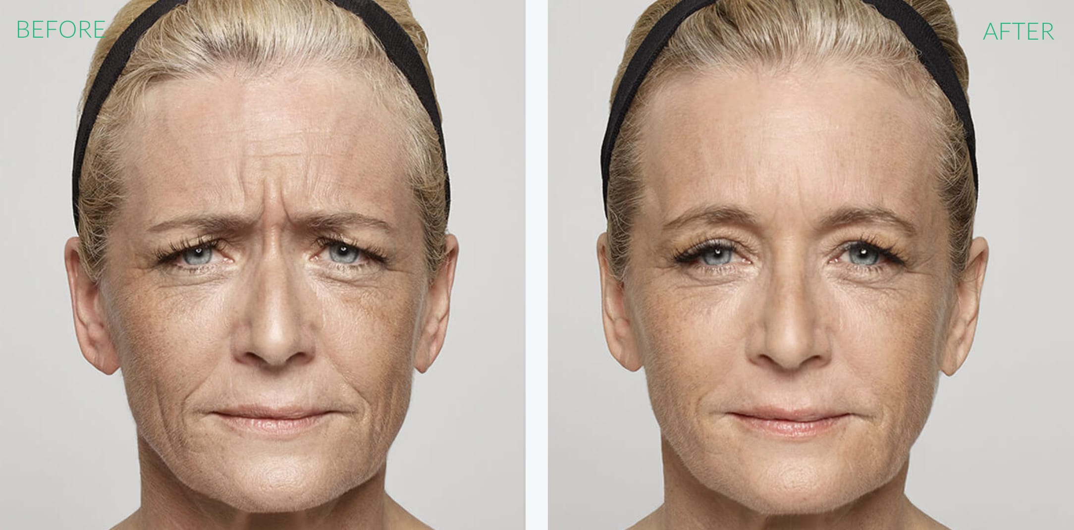 Dysport Before & After
