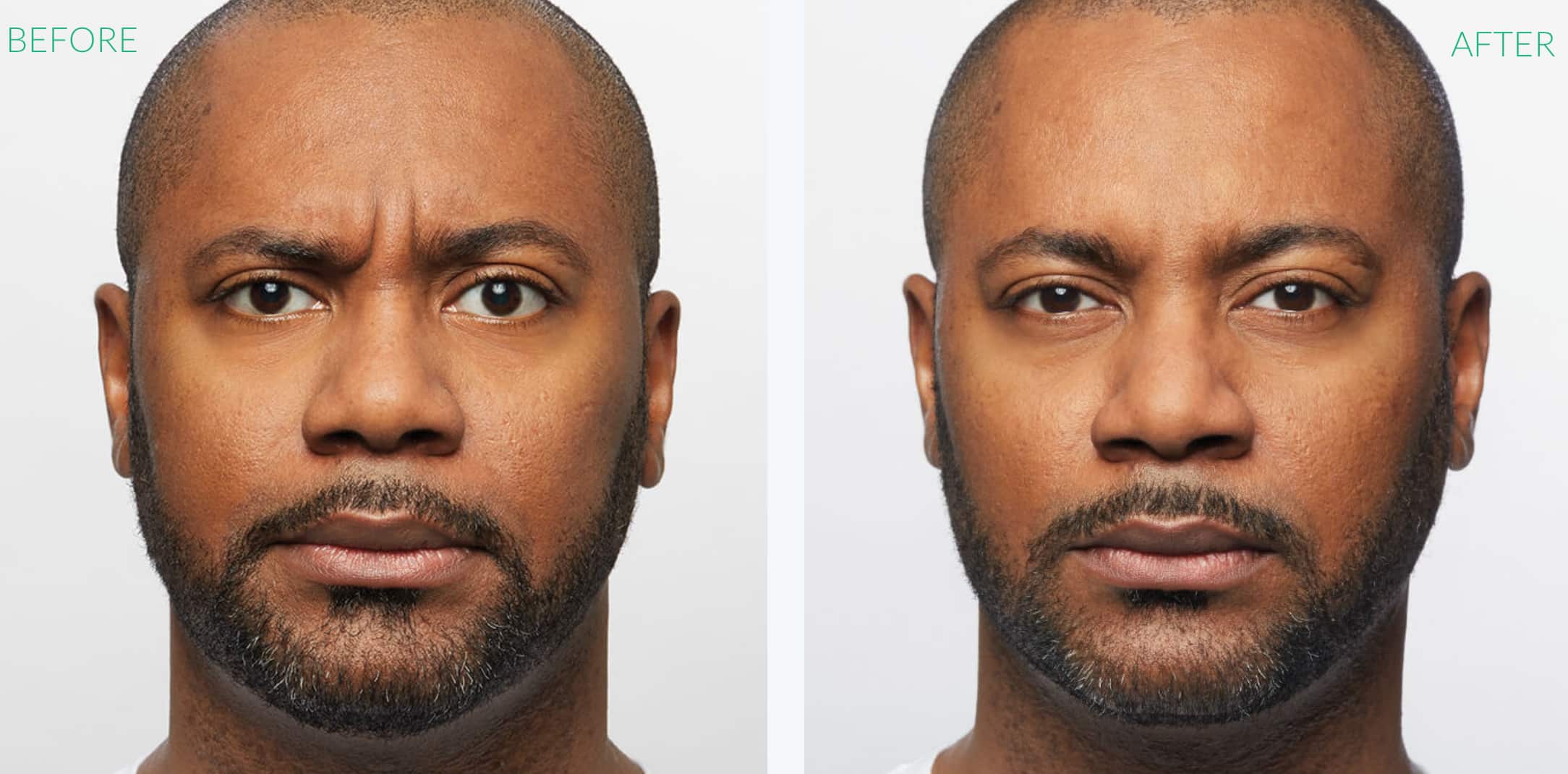 Dysport Before & After